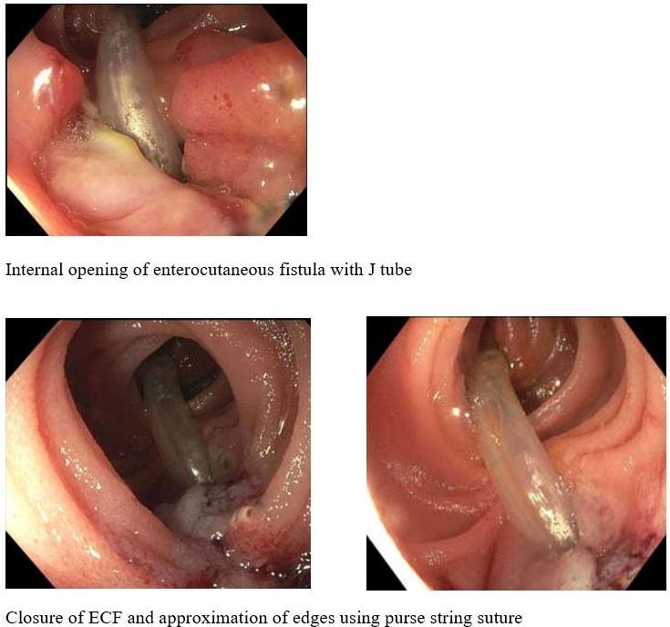 Percutaneous Purse-String Suture: An Innovative Percutaneous Technique for  Inframammary Fold Creation and Improved Breast Projection in Reconstructive  Surgery | Aesthetic Surgery Journal | Oxford Academic